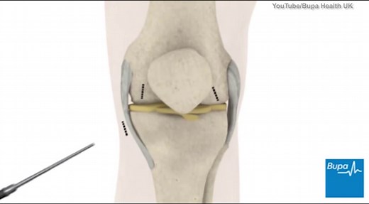 Explanation of how keyhole knee surgery works