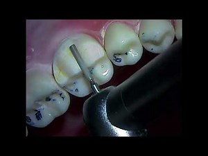 Teaching Dentistry: Typodont equilibration and Mx and Md occlusal reduction