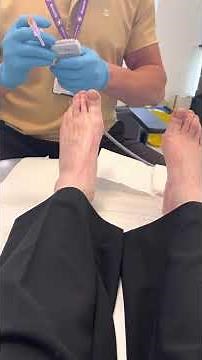 Morton’s neuroma injection under ultrasound guidance