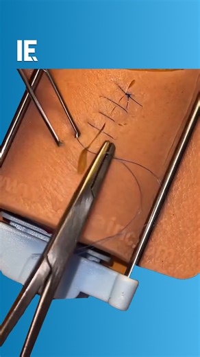 394K views · 1.3K reactions | It takes skill and a steady hand to stitch continuous stitches like these.  doctor.sutura / IG | Interesting Engineering | Facebook
