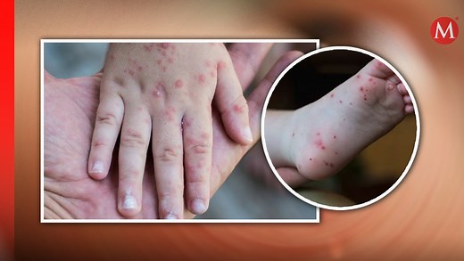 Virus coxsackie: Qué es, síntomas y cómo se contagia