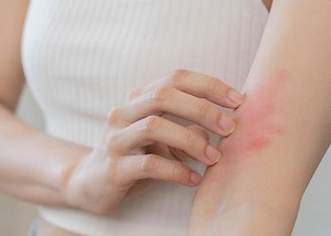 Getting Down to the Root Cause of Hives