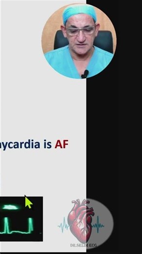 Irregular narrow complex tachycardia with pulse 3