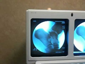 Intraoperative Fluoroscopy of Anterior Drawer in Ankle Instability, SFSIM