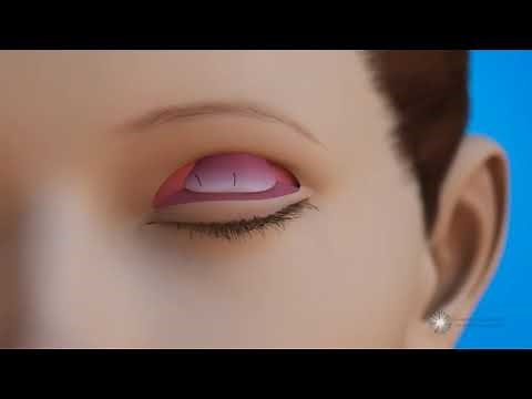 Opération du ptosis - Résection du releveur de la paupière supérieure