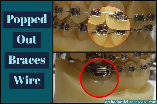Braces Wire Popped Out Of Bracket: Causes, What To Do - Orthodontic Braces Care