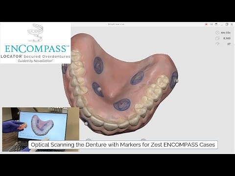 ENCOMPASS Step 3: Optical Scanning the Denture with Markers for Zest ENCOMPASS Case Workup