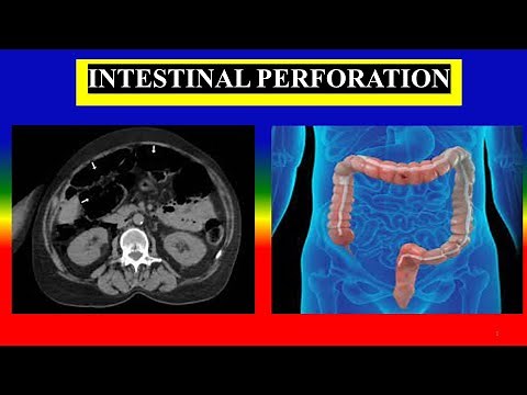 INTESTINAL PERFORATION - Define , causes , symptoms , diagnostic , treatment , complications