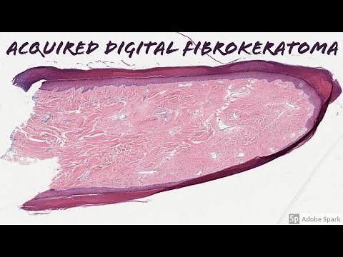 Acquired Digital Fibrokeratoma: 5-Minute Pathology Pearls