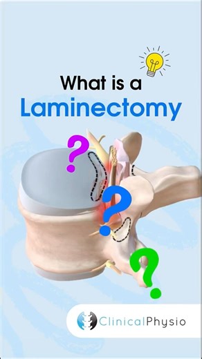 Laminectomy #physicaltherapy #physicaltherapy #laminectomy #backsurgery #spine