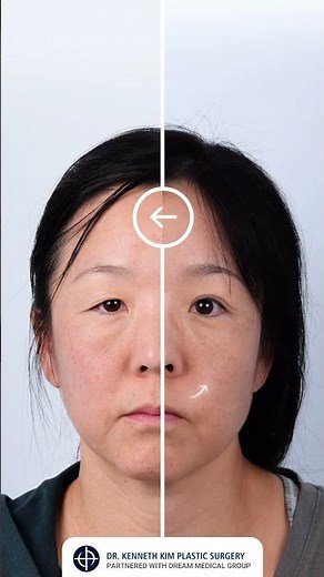 Double Eyelid Surgery: Transforming Hooded Eyelids for a Brighter, Youthful Look