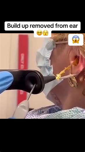 Wax taken out from ear #satisfying #skincare #beauty #popping
