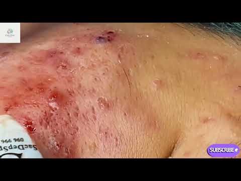 Chest Acne NIGHTMARE – 50+ Blackheads & Pimples Complete Extraction 😱
