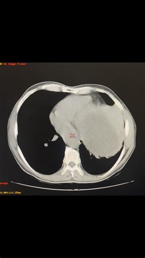 A 55-year-old patient presented with severe abdominal pain and underwent a non-contrast and contrast-enhanced abdominal CT along with an abdominal CT angiogram. The imaging revealed a giant Bosniak III renal cyst—a complex lesion requiring careful evaluation—and an accessory left renal artery, a common but surgically significant anatomical variant. #ctscan #abdomen Credit: Leo Javier | Sobat Radiology