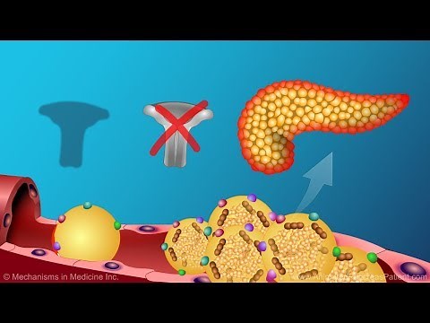 Understanding Familial Chylomicronemia Syndrome (FCS)
