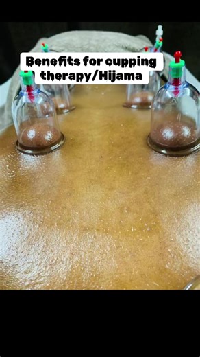 Cupping therapy #hijamatherapy #cuppingtherapy #taomiesbeautyspa #massagetherapy #deeptissuemassage
