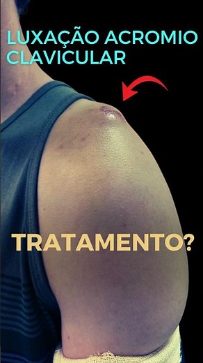 Luxação acromioclavicular #luxaçãoacromioclavicular
