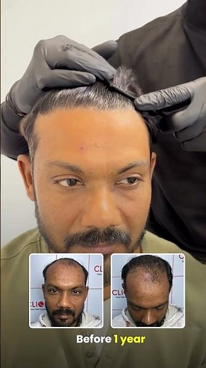 12 Months Hair Transplant Result | Real Patient Journey & Final Outcome