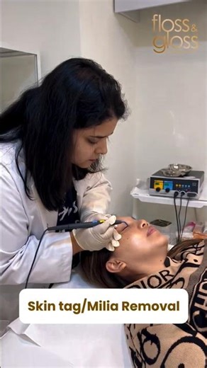 Quick cautery treatment for unwanted skin lesions — minimal downtime, maximum care.#MedicalCautery