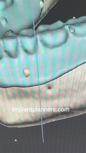 #surgical #guide #3dprinting #laboratory #implantplanners.com