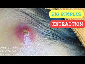 Super big acne,super big pimples,Dermatologist|Mụn nhọt siêu khổng lồ trên trán nặn ra đầy mủ
