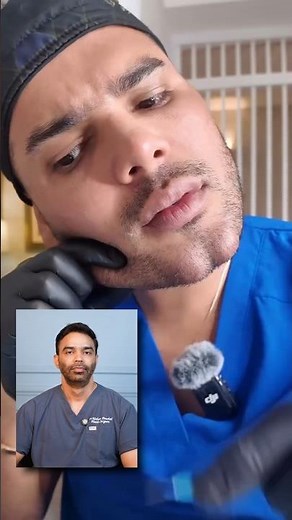 How should Facial Fillers be placed ?