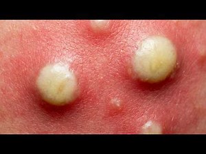 Loan Nguyen Acne Treatment 20jj