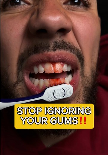 Take better care of your gum health‼️😳@Puneet Nanda bridge the gap @GuruNanda LLC #gurunanda
