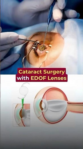 Cataract Surgery with EDOF Lenses - Dr. Advaith Sai Alampur | Envision LASIK Centre