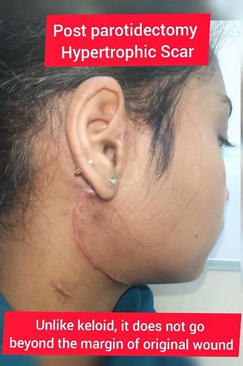 Post-parotidectomy hypertrophic scar.