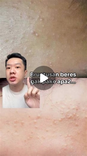 Ricky on Instagram: "Perhatiin juga hairstyling products lainnya kayak hair spray, hair wax, pomade dll. Make sure cleansing yg maksimal terutama di area jidat yg paling beresiko muncul bruntusan akibat akumulasi residu dari hair products. Ini cuma tips, semoga bisa works juga di kalian… Urutan mandi (rekomendasi dokter kulit): shampoo bilas - conditioner bilas (optional) - body wash bilas - gosok gigi - face wash bilas. Citation: https://www.aad.org/public/diseases/acne/causes/hair-products"
