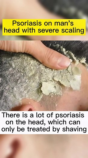Understanding Psoriasis: A Warrior's Journey