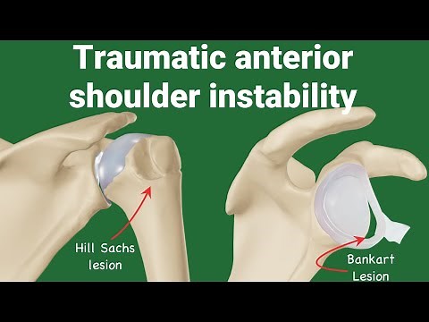 Pathologies of Traumatic Anterior Shoulder Instability (TUBS) animation