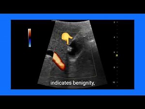 Gallbladder Polyps Explained: Ultrasound & color Doppler Findings, Diagnosis, and Management