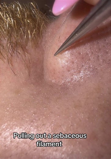 Pulling out a sebaceous filament ♥️ #pimplepopper