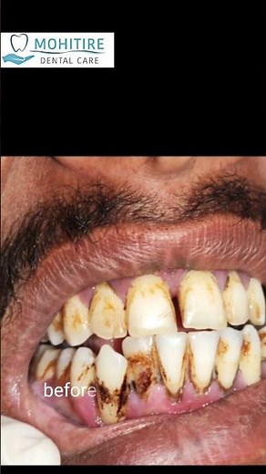 From Yellow to Clean! Crazy Satisfying Teeth Cleaning (Ultrasonic Scaling)