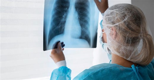 Cáncer de pulmón: así es uno de los tumores más agresivos y que ha causado la muerte a Julián Muñoz