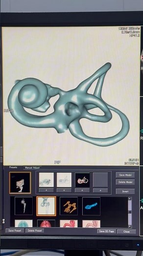 CT Scan of Inner Ear: HRCT Temporal Bone for Cochlear Implant with 3D Images Explained #viral #hits