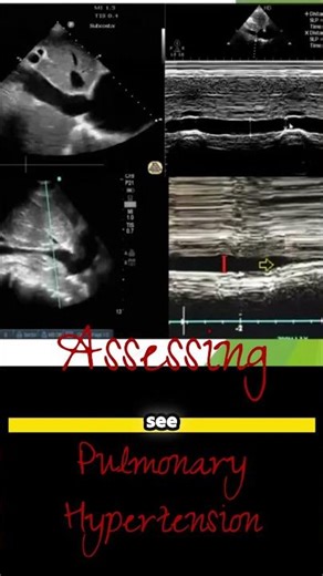 Tricuspid Regurgitation Made Easy 😱 You’ll Never Forget This!