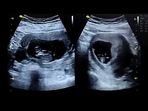 11 WEEKS GESTATION THE BABY IS ALREADY MOVING ITS FEET 👣