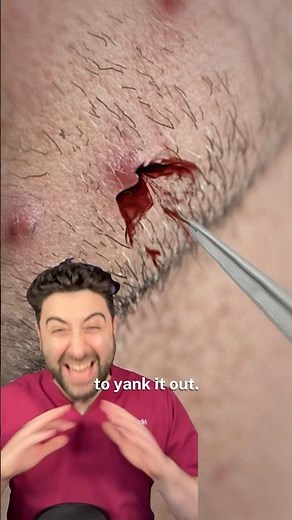 How to get rid of ingrown hairs