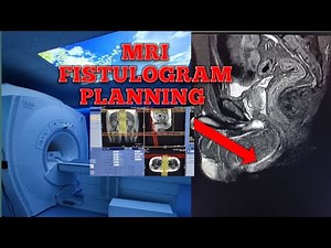 MRI FISTULOGRAM PLANNING @MRI FISTULAGRAM PLANNING STEP BY STEP #MRI FISTULA PLAN