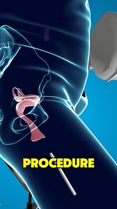 Hysteroscopic Polypectomy Surgery (3D Animation) #facts #randomfacts #learnontiktok #curiosity #satisfying #satisfyingvideos | MindfulFacts