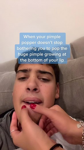 Effective Ways to Deal with Pimples Below the Lip