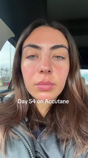 Day 54 on Accutane: My Ongoing Skin Transformation