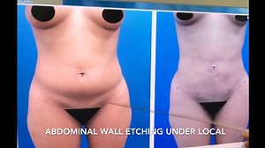 Abdominal Sculpting with Tickle Lipo Under Local Anesthesia by Dr. Kevin Tehrani