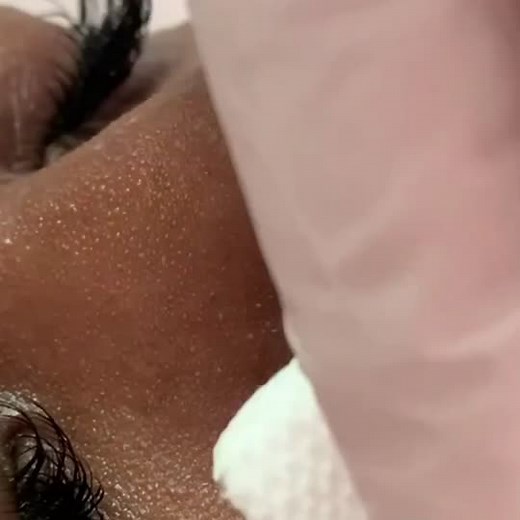 #extraction #extractionsatisfaction #fyp #smallbusiness #toronto #lebanesecanadian #esthetics #MillennialsOfTikTok