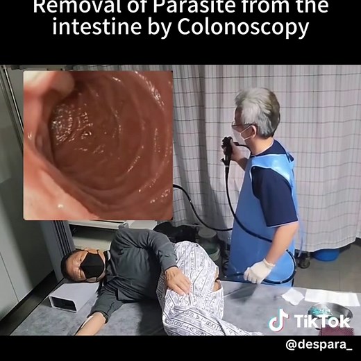 Intestinal parasites can be effectively removed through a colonoscopy procedure video from：tiktok @doctorbenkim #creatorsearchinsights #intestino #colonoscopy #colonoscopia #endoscopy #endoscopiadigestiva #satisfyingvideo #viral #fyp #foryou #foryoupage #fypシ #parasite #parasites