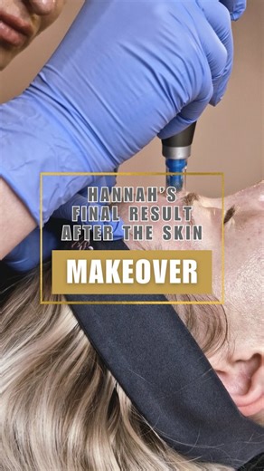 Hannah’s results from The Skin Makeover are in 😍 A few months of personalised #SkinScience have brought Hannah’s skin to a renewed state of calm and clarity. Through a series of customised in-clinic treatments, including our signature 3D MD PRP, 3D Medical Skin Needling and 3D Bespoke, as well as customised chemical peels, we achieved stunning results. Her home care was essential in achieving these results... We are truly grateful to our product partners for supporting this transformation! Hann