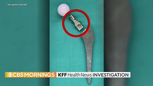 1.6K views · 22 reactions | Reports were made to the FDA about a titanium hip implant breaking inside patients in the U.S. as early as 2005, CBS News and KFF Health News found. Yet, it took 15 years for any Profemur recalls. By that time, more than 800 reports of fractures had been made. https://cbsn.ws/481SQ4P | CBS Mornings | Facebook